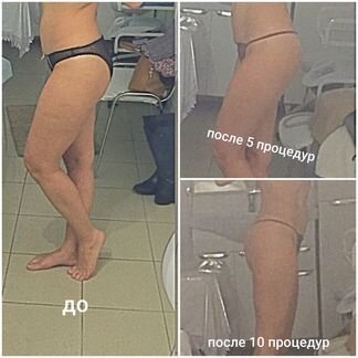LPG массаж на аппарате бютилайнер